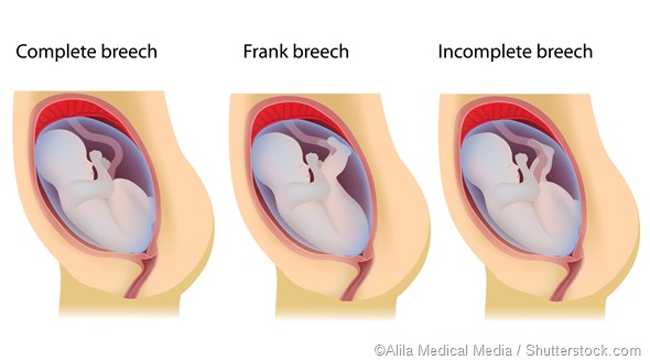 Breech birth positions